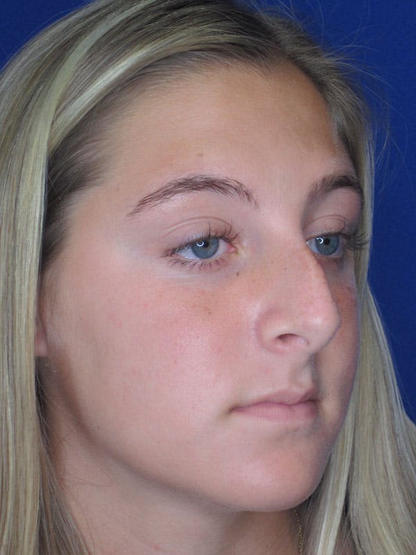 Rhinoplasty Before & After Gallery - Patient 92118228 - Image 3