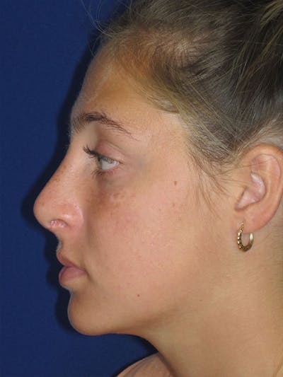 Rhinoplasty Before & After Gallery - Patient 92118228 - Image 6