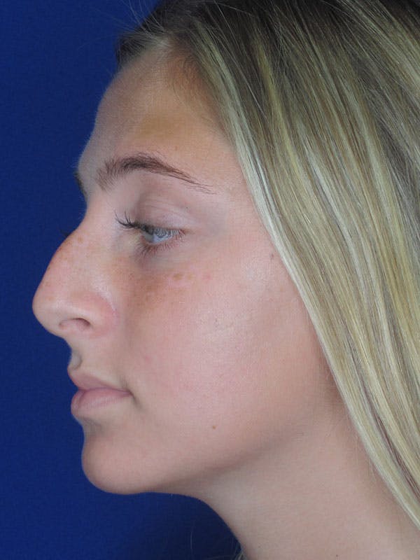 Rhinoplasty Before & After Gallery - Patient 92118228 - Image 5