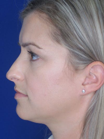 Rhinoplasty Before & After Gallery - Patient 92120204 - Image 1