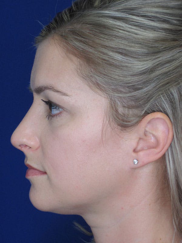 Rhinoplasty Before & After Gallery - Patient 92120204 - Image 2