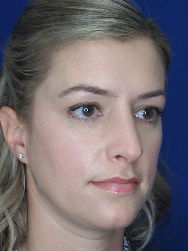 Rhinoplasty Before & After Gallery - Patient 92120204 - Image 4