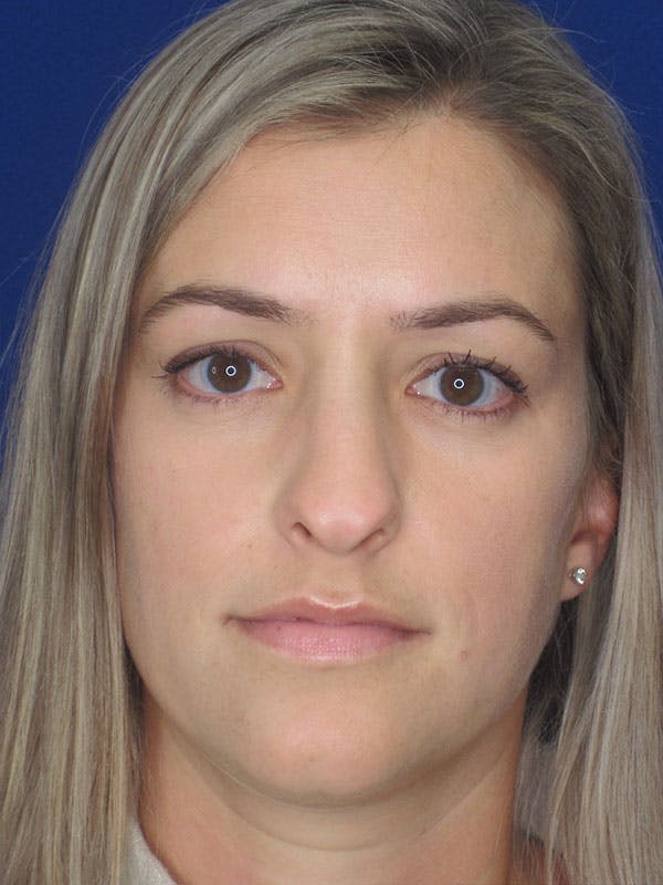Rhinoplasty Before & After Gallery - Patient 92120204 - Image 5