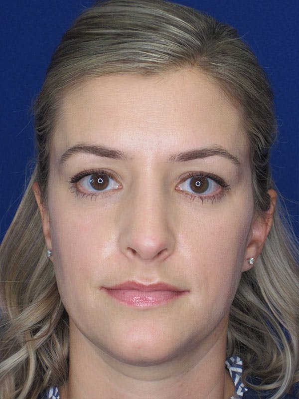 Rhinoplasty Before & After Gallery - Patient 92120204 - Image 6