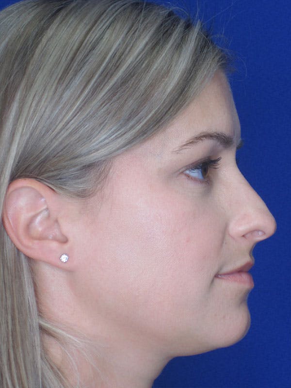 Rhinoplasty Before & After Gallery - Patient 92120204 - Image 7