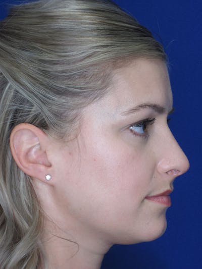 Rhinoplasty Before & After Gallery - Patient 92120204 - Image 8