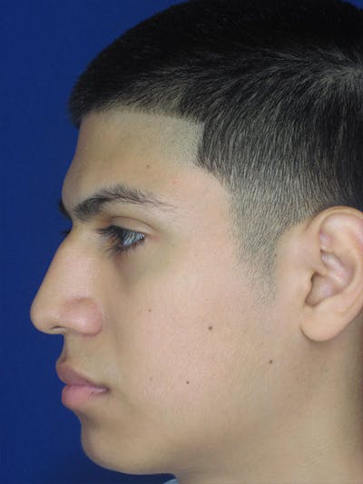 Rhinoplasty Before & After Gallery - Patient 92120211 - Image 1