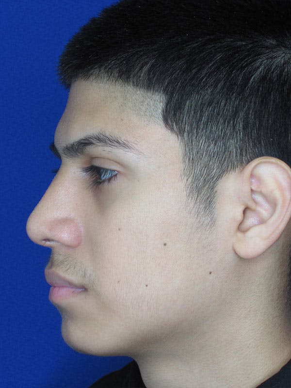 Rhinoplasty Before & After Gallery - Patient 92120211 - Image 2