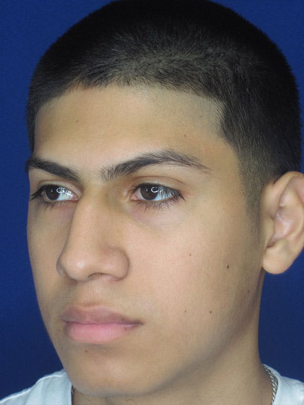 Rhinoplasty Before & After Gallery - Patient 92120211 - Image 3