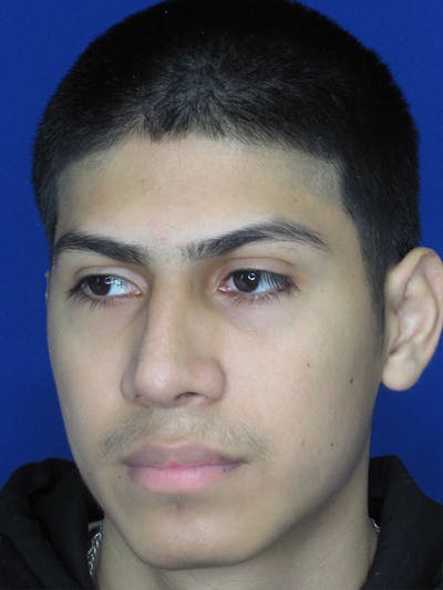 Rhinoplasty Before & After Gallery - Patient 92120211 - Image 4