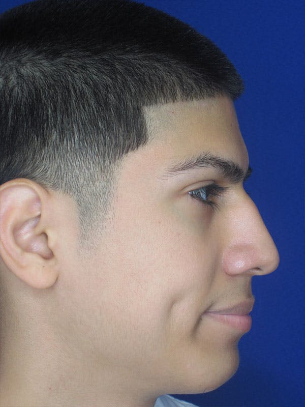Rhinoplasty Before & After Gallery - Patient 92120211 - Image 5