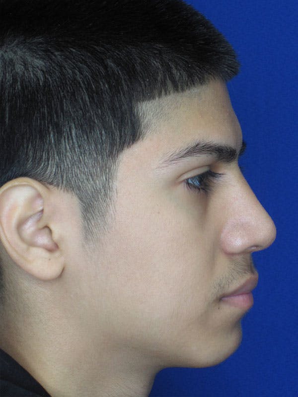 Rhinoplasty Before & After Gallery - Patient 92120211 - Image 6