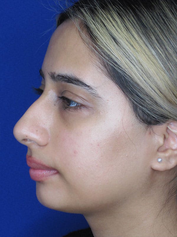 Rhinoplasty Before & After Gallery - Patient 92120213 - Image 3