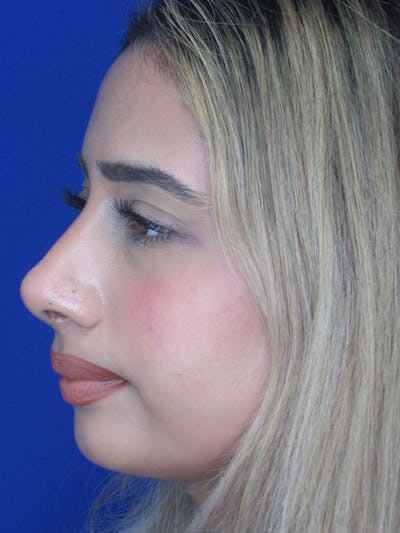 Rhinoplasty Before & After Gallery - Patient 92120213 - Image 4