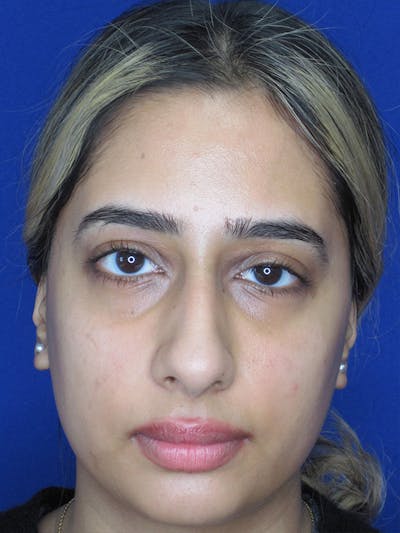 Rhinoplasty Before & After Gallery - Patient 92120213 - Image 1
