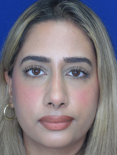 Rhinoplasty Before & After Gallery - Patient 92120213 - Image 2