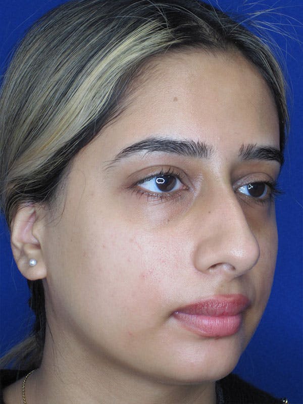 Rhinoplasty Before & After Gallery - Patient 92120213 - Image 5