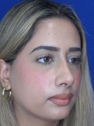Rhinoplasty Before & After Gallery - Patient 92120213 - Image 6