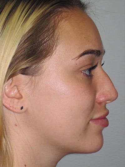 Rhinoplasty Before & After Gallery - Patient 92120222 - Image 1