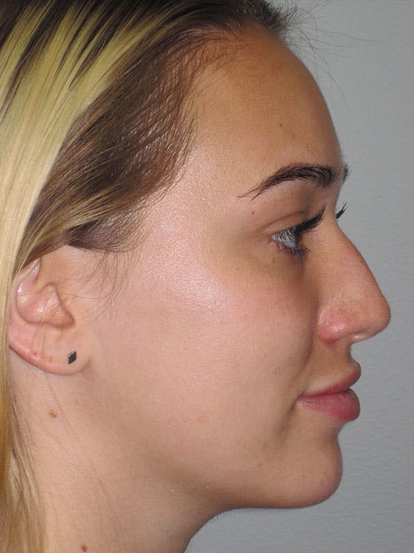 Rhinoplasty Before & After Gallery - Patient 92120222 - Image 1