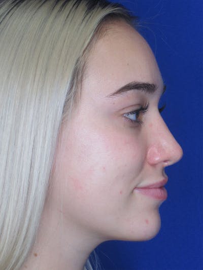 Rhinoplasty Before & After Gallery - Patient 92120222 - Image 2