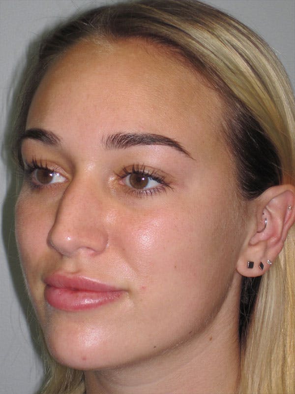 Rhinoplasty Before & After Gallery - Patient 92120222 - Image 3