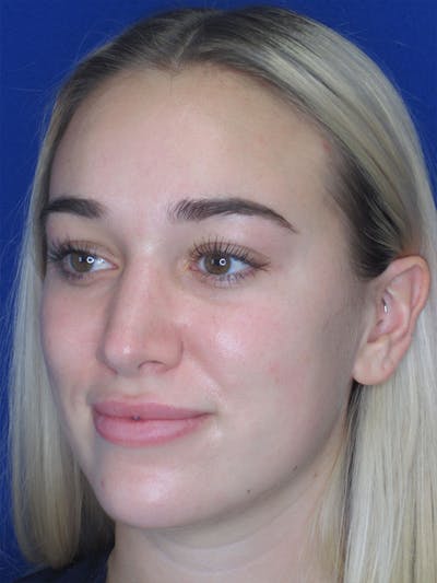 Rhinoplasty Before & After Gallery - Patient 92120222 - Image 4