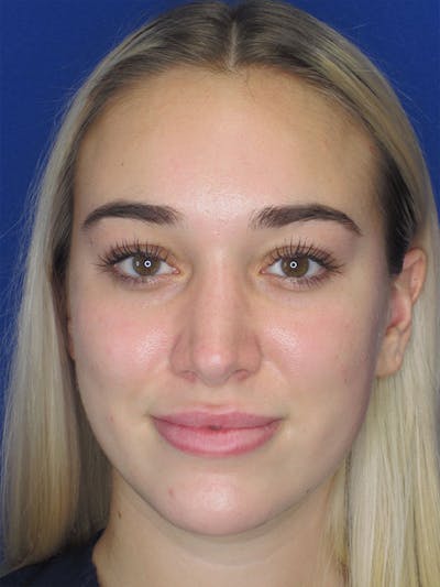 Rhinoplasty Before & After Gallery - Patient 92120222 - Image 6