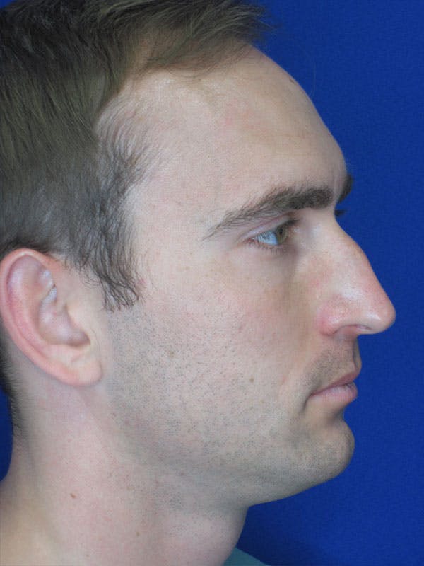 Rhinoplasty Before & After Gallery - Patient 92120258 - Image 5
