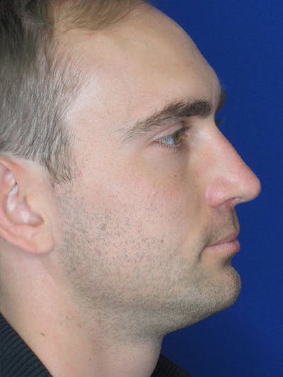 Rhinoplasty Before & After Gallery - Patient 92120258 - Image 6