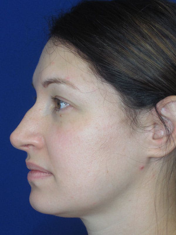 Rhinoplasty Before & After Gallery - Patient 92120259 - Image 1