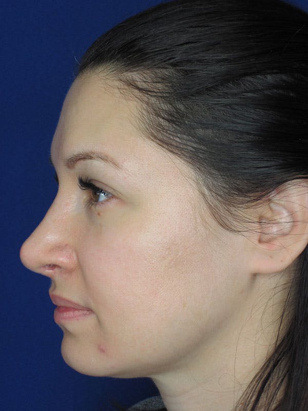 Rhinoplasty Before & After Gallery - Patient 92120259 - Image 2
