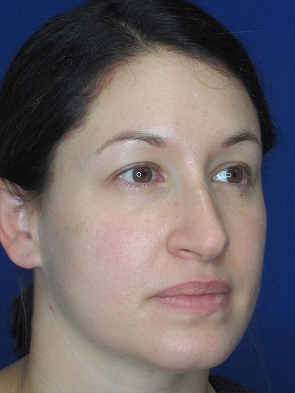 Rhinoplasty Before & After Gallery - Patient 92120259 - Image 3