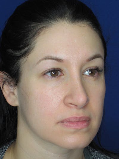 Rhinoplasty Before & After Gallery - Patient 92120259 - Image 4