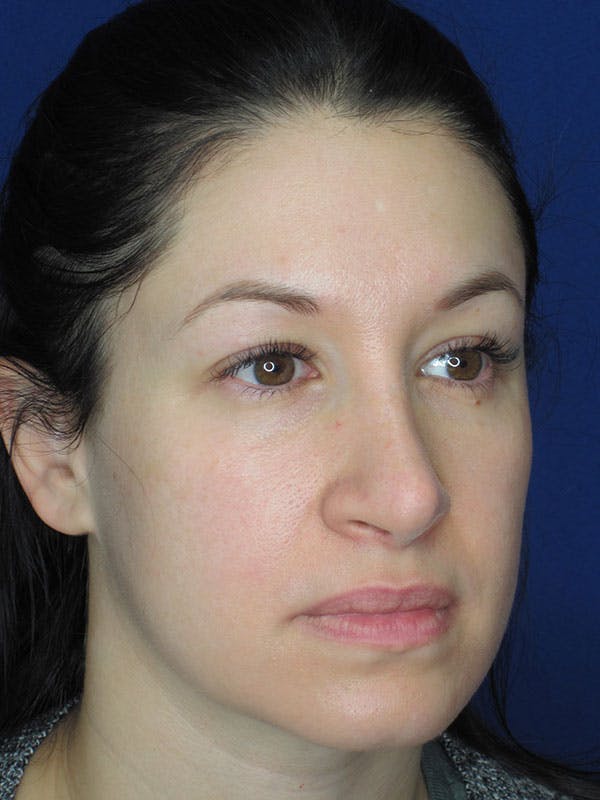 Rhinoplasty Before & After Gallery - Patient 92120259 - Image 4