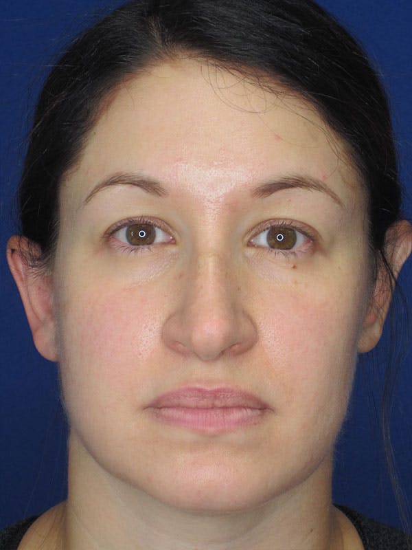 Rhinoplasty Before & After Gallery - Patient 92120259 - Image 5