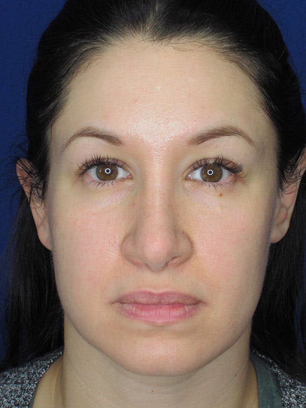 Rhinoplasty Before & After Gallery - Patient 92120259 - Image 6