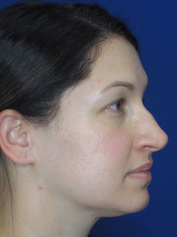 Rhinoplasty Before & After Gallery - Patient 92120259 - Image 7