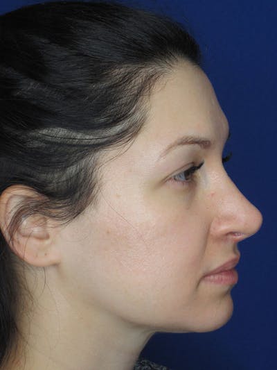 Rhinoplasty Before & After Gallery - Patient 92120259 - Image 8