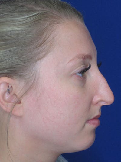 Rhinoplasty Before & After Gallery - Patient 92120260 - Image 1