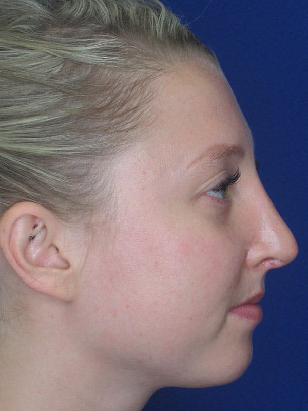 Rhinoplasty Before & After Gallery - Patient 92120260 - Image 2