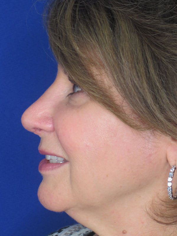 Rhinoplasty Before & After Gallery - Patient 92120374 - Image 4