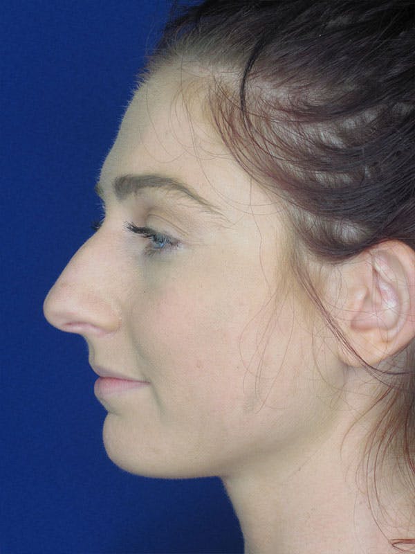 Rhinoplasty Before & After Gallery - Patient 92120378 - Image 1