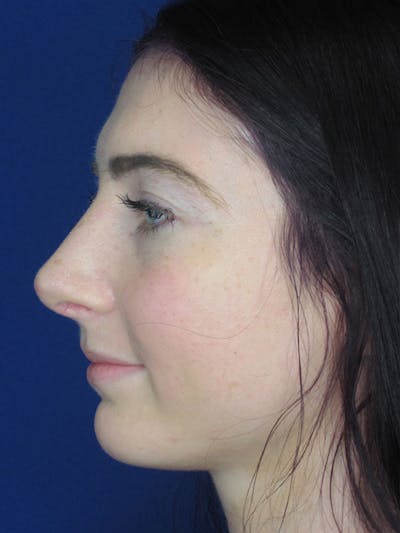 Rhinoplasty Before & After Gallery - Patient 92120378 - Image 2