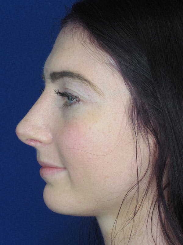 Rhinoplasty Before & After Gallery - Patient 92120378 - Image 2