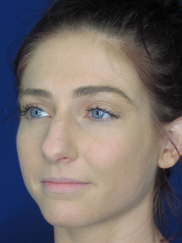 Rhinoplasty Before & After Gallery - Patient 92120378 - Image 3