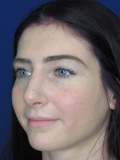 Rhinoplasty Before & After Gallery - Patient 92120378 - Image 4