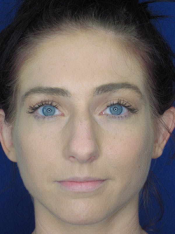 Rhinoplasty Before & After Gallery - Patient 92120378 - Image 5