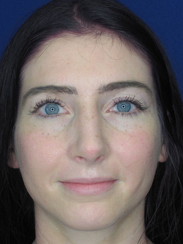 Rhinoplasty Before & After Gallery - Patient 92120378 - Image 6