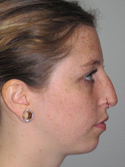Rhinoplasty Before & After Gallery - Patient 92120380 - Image 1